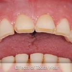 Effects of Tooth Wear