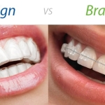 Invisalign vs Braces