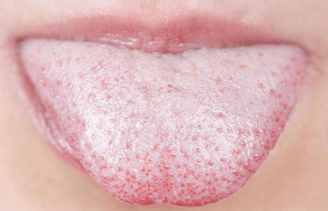 candida infection in mouth