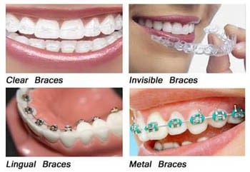 Different types of orthodontic braces