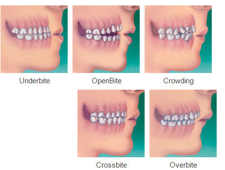 All Type of Bites