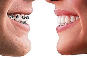 Traditional braces vs. Invisalign aligners