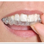 Invisalign aligners cost