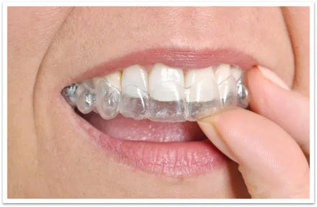 Navigating the Cost of Invisalign® Treatment