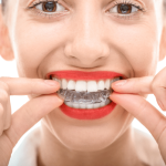 invisalign aligners newcastle wa