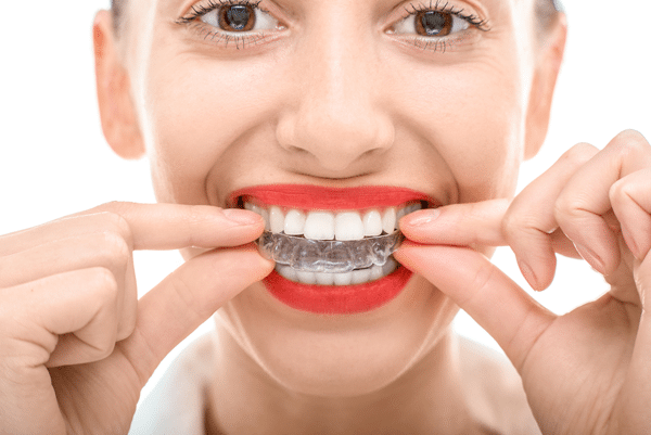 invisalign aligners newcastle wa