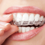 invisalign vs smile direct club