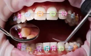 Braces 101: Your Ultimate Guide to Orthodontic Success