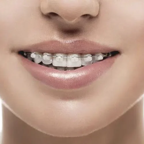 oe-smiles-ceramic-braces.jpg