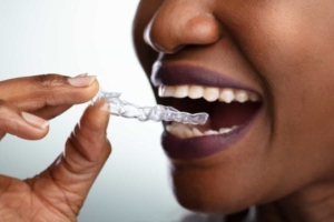 benefits of Invisalign