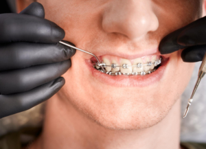 Braces 101: Your Ultimate Guide to Orthodontic Success