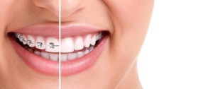 Which Braces Are Right for You? Find the Best Fit for Your Smile