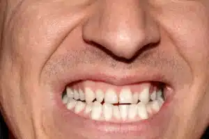 Adult Orthodontics Options for Older Patients