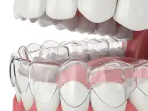 How Invisalign Works Clear Aligner Treatment Explained