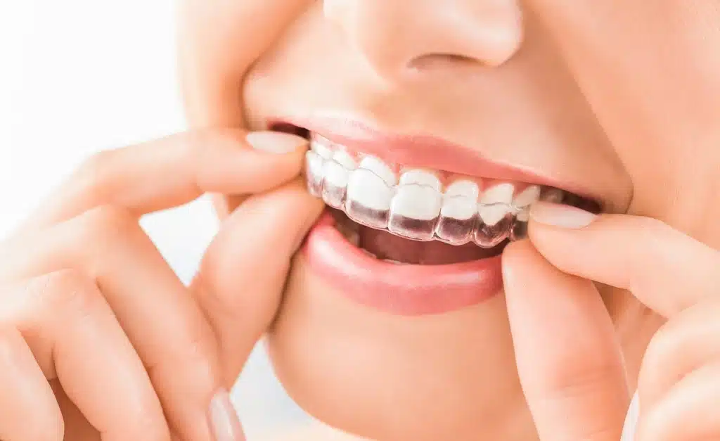 Close-up of a person placing clear aligners on teeth during Invisalign Mercer Island treatment