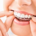 Close-up of a person placing clear aligners on teeth during Invisalign Mercer Island treatment