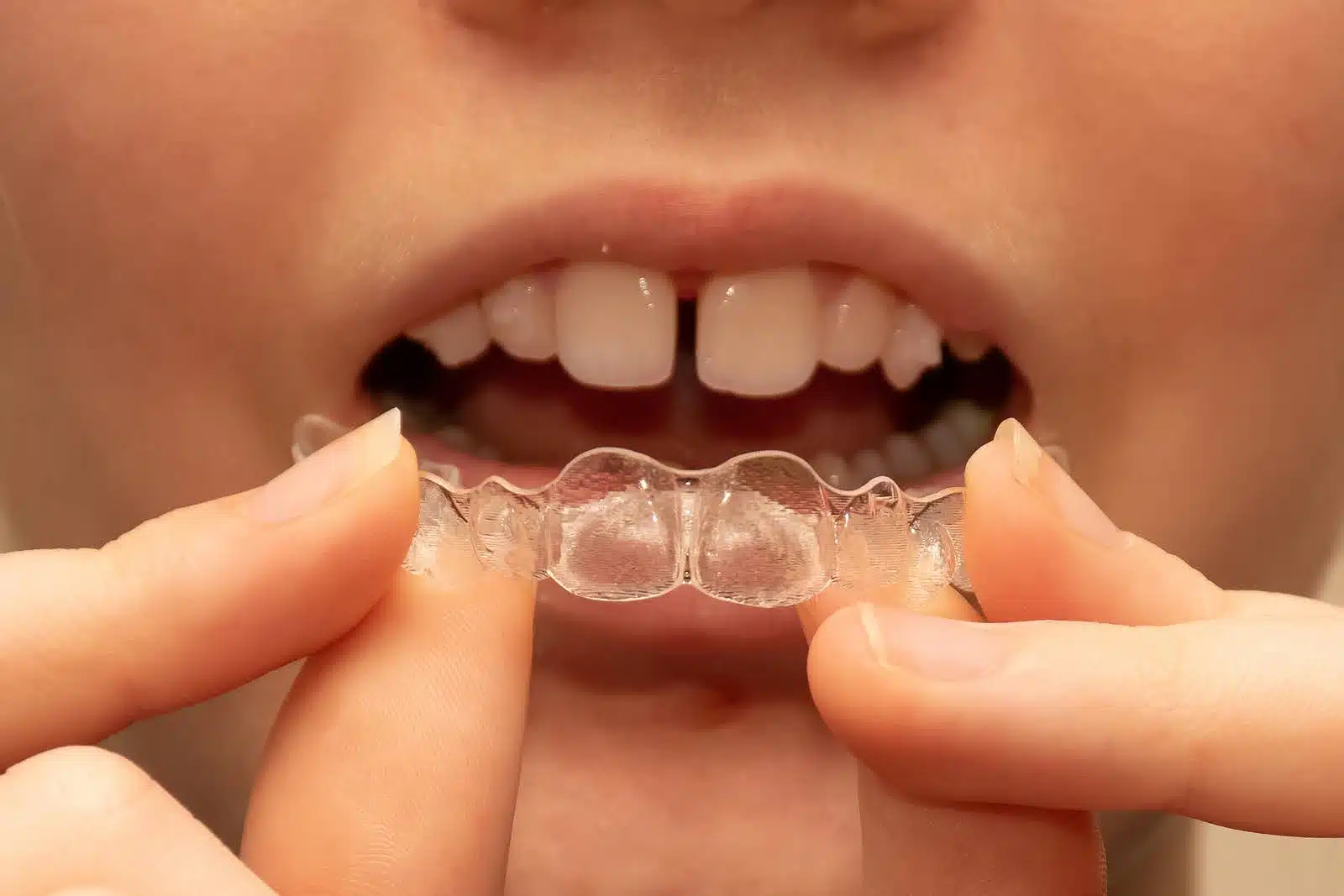 Patient holding removable aligners in front of teeth illustrating the Invisalign treatment process