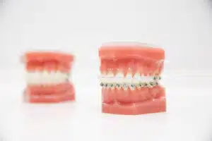 Orthodontic Care Tips Using Braces Models