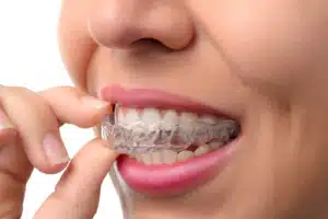 Patient placing a clear tray over teeth during clear aligner treatment process