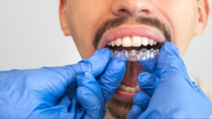 Orthodontist placing a clear aligner tray onto a patient's upper teeth