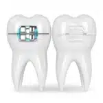 D render comparing traditional metal braces and clear ceramic braces on teeth models.