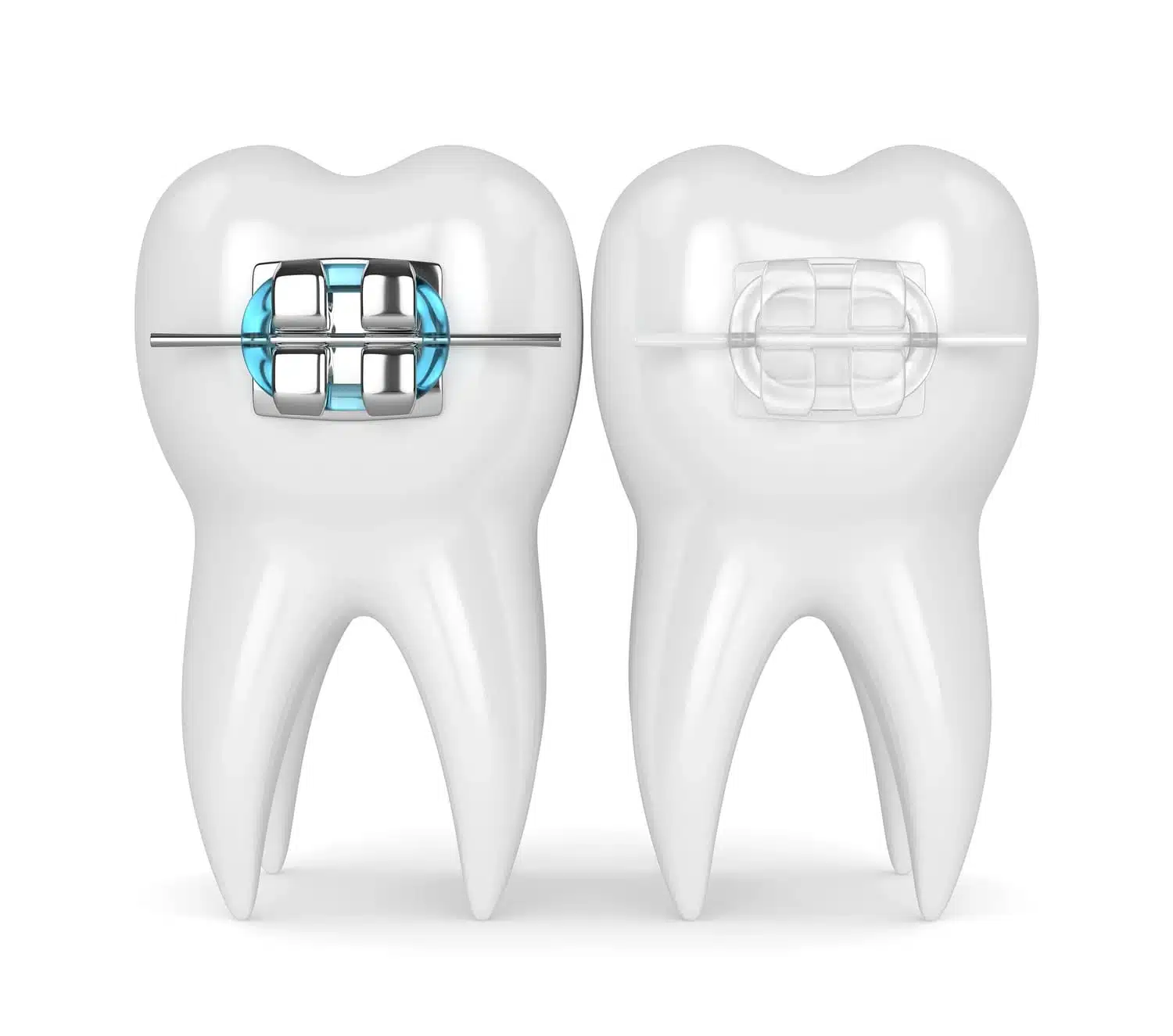 D render comparing traditional metal braces and clear ceramic braces on teeth models.