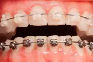 Macro view of clear ceramic brackets on the upper teeth and metal brackets on the lower.