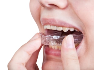 A young woman placing a clear orthodontic aligner in her mouth.
