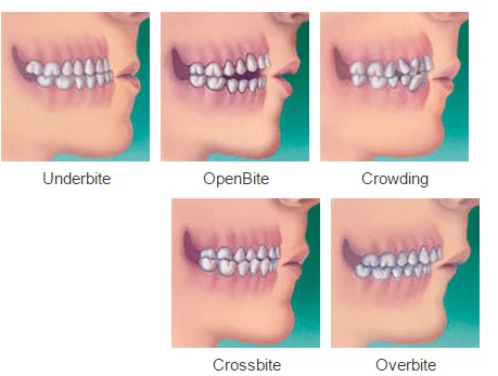 All Type of Bites